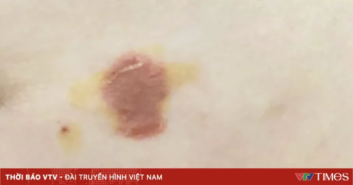 Cảnh giác bệnh chốc lở ở trẻ em mùa hè